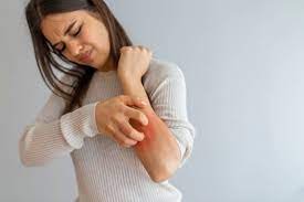 Eczema relief cupping therapy